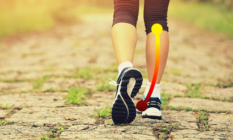 overpronation