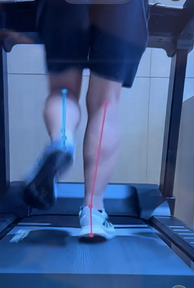 overpronation