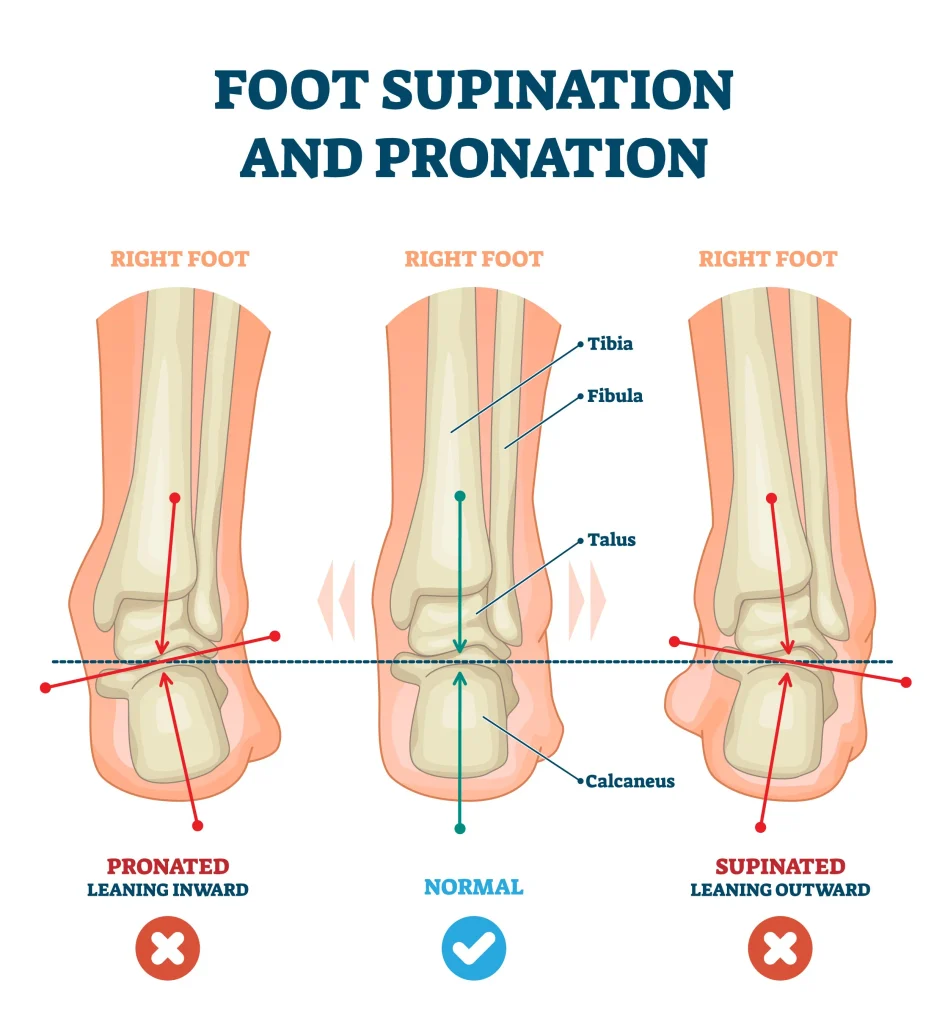 overpronation
